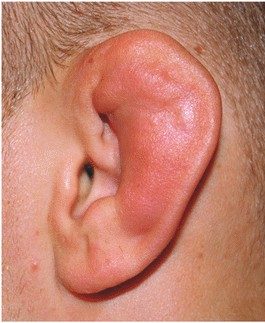 How to avoid Cauliflower Ear BJJ